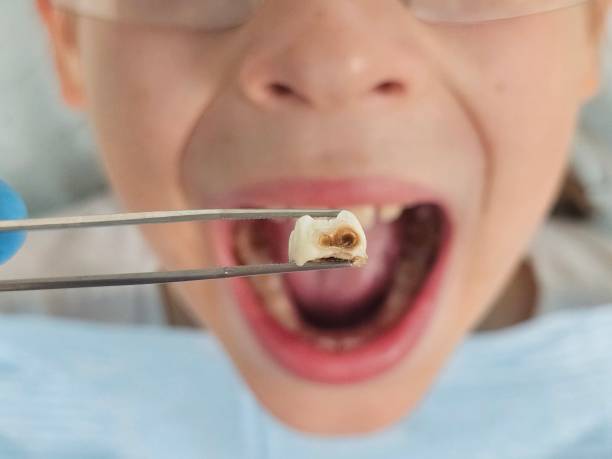Best Same-Day Emergency Dental Services in Millersport, OH